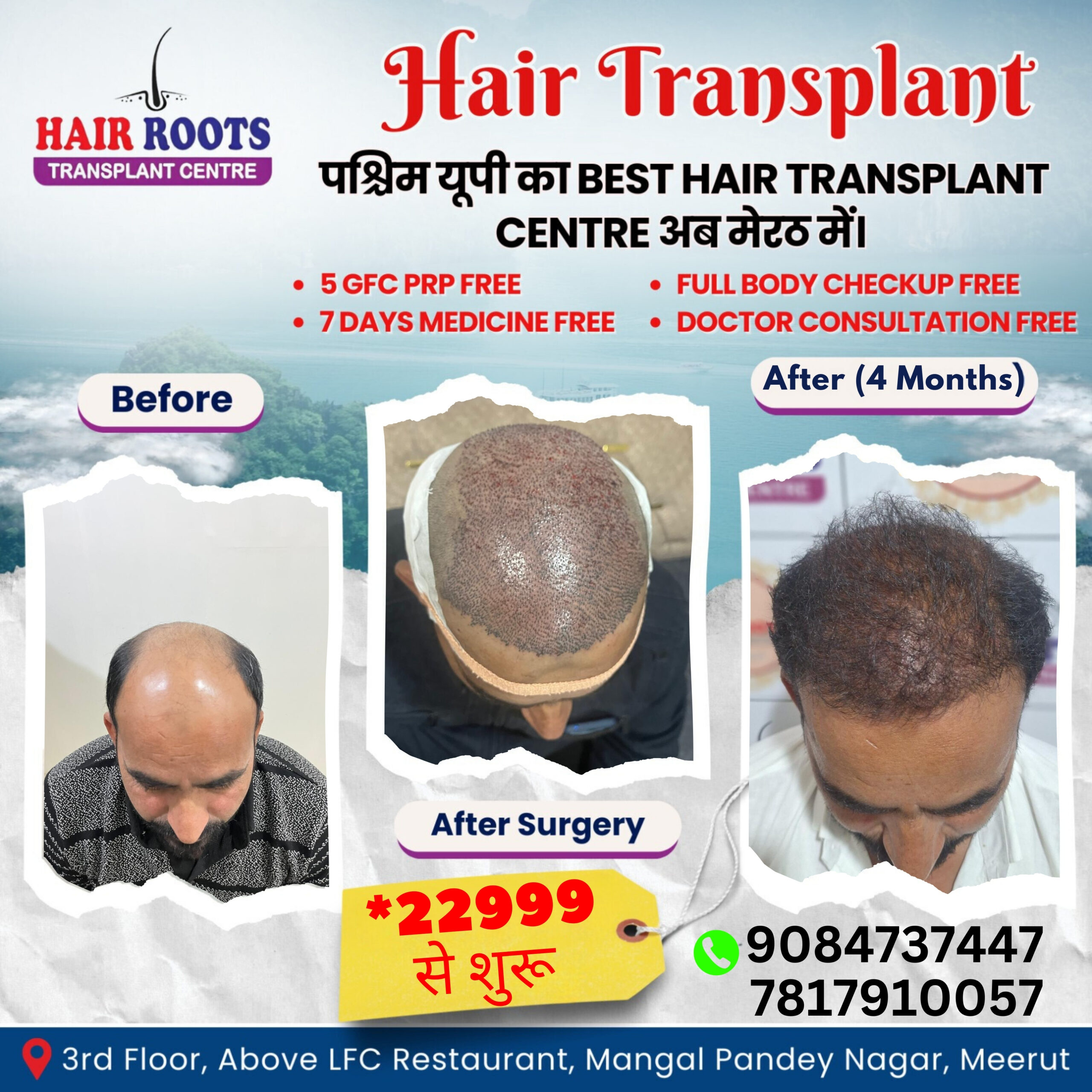 Discover the Best Hair Transplant in Meerut for Natural, Lasting Results