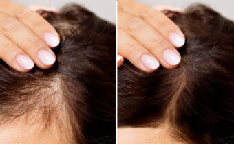 Hair Loss and Its Home Remedies: A Guide to Healthy Hair