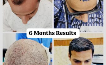 Achieve Fuller Hair with the Best Hair Transplant in Meerut