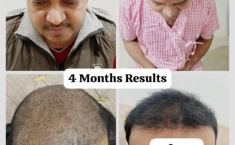 Hair Transplant Results: What to Expect Before and After