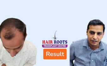 Transforming Hair with Proven Results at Hair Root Transplant Center, Meerut