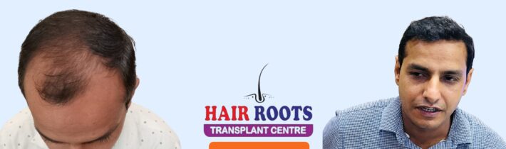 Transforming Hair with Proven Results at Hair Root Transplant Center, Meerut