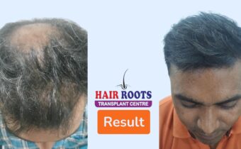 Hair Transplant: The Amazing Transformation—Before and After