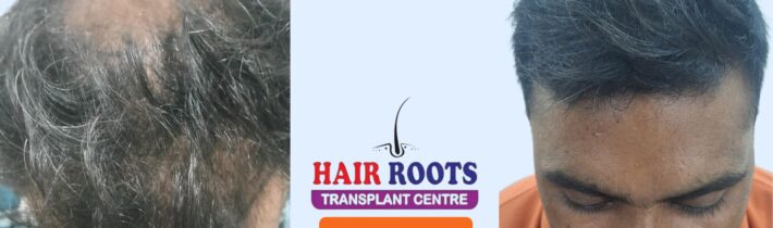 Hair Transplant: The Amazing Transformation—Before and After