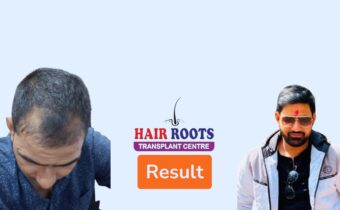 Achieving the Best Hair Transplant Results in West Uttar Pradesh