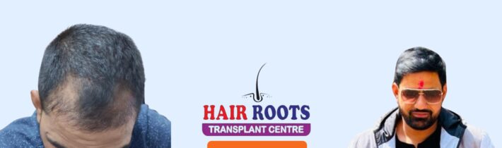 Achieving the Best Hair Transplant Results in West Uttar Pradesh