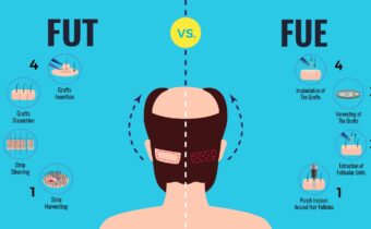 Best Hair Transplant Techniques: Which One is Right for You?