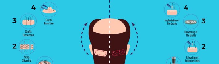 Best Hair Transplant Techniques: Which One is Right for You?