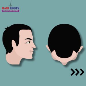 Hair loss can be a journey with varying stages that each require unique approaches to treatment.