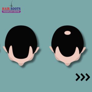 Hair loss can be a journey with varying stages that each require unique approaches to treatment.