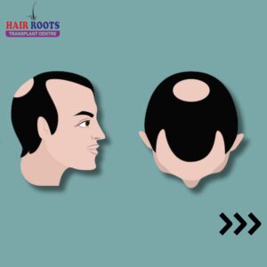 Hair loss can be a journey with varying stages that each require unique approaches to treatment.