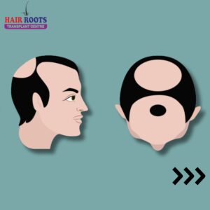 Hair loss can be a journey with varying stages that each require unique approaches to treatment.