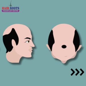 Hair loss can be a journey with varying stages that each require unique approaches to treatment.