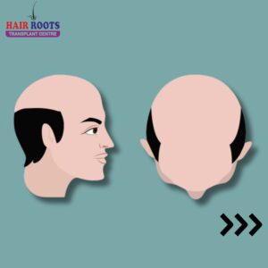 Understanding the Stages of Hair Loss: When Is Hair Transplant the Right Solution?