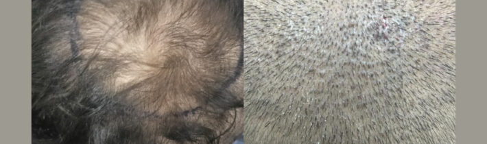 Achieving the Best Hair Transplant Results for Crown Restoration in Meerut, Hair Roots Meerut.