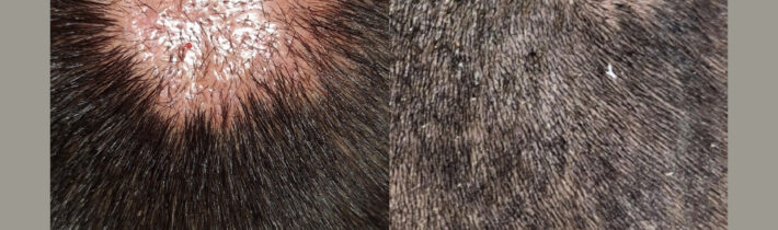 Patient Success Story: Restoring Hair Lost Due to Injury—A Journey of Recovery with Hair Transplant in Meerut