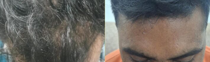 Transforming Lives with Proven Hair Transplant Results at Hair Roots Transplant Center